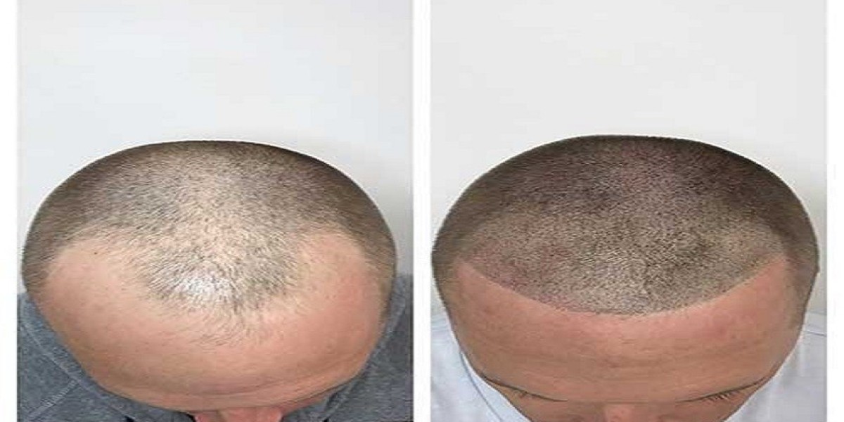 How Proper Hair Care Can Help Manage Alopecia and Hair Fall