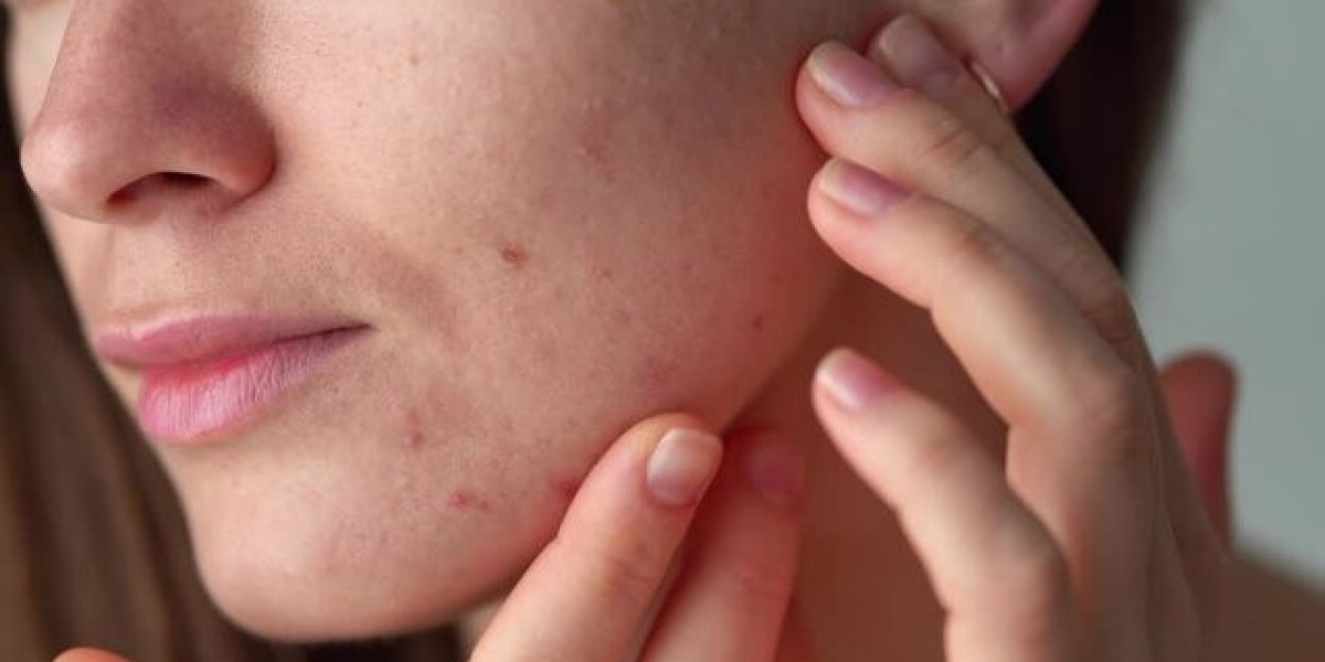 Best Acne Treatment Products in Pakistan Dermatologists Actually Recommend