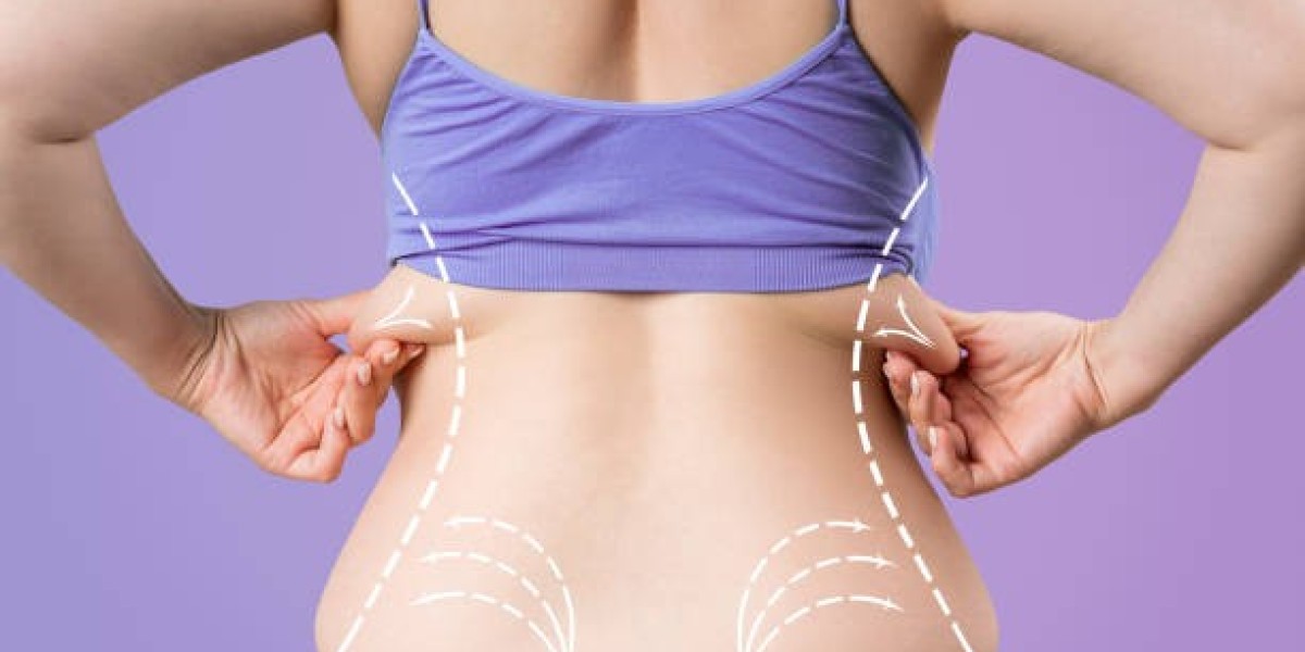 Liposuction for the Abdomen: What Patients Should Know