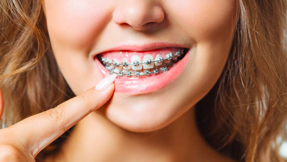 Braces in Sacramento | Braces in Natomas | Braaces in Auburn