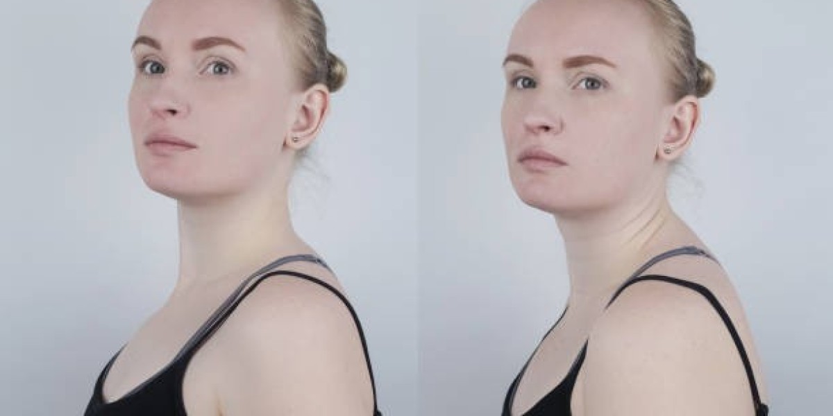 Long-Lasting Results of Buffalo Hump Removal in Riyadh