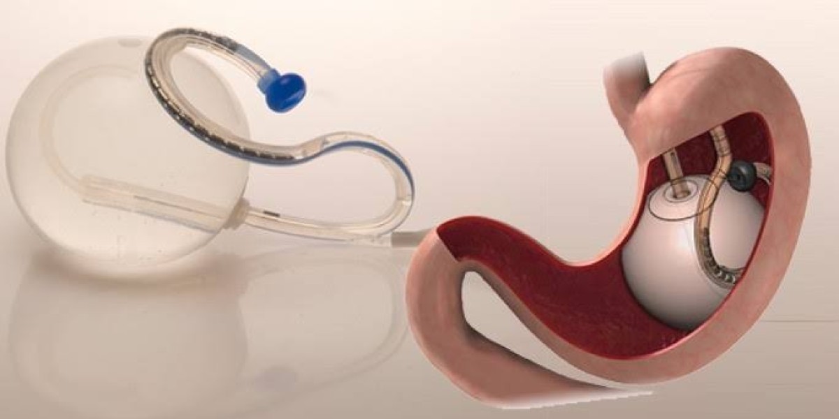 Top 5 Clinics in Dubai for Allurion Gastric Balloon Treatment