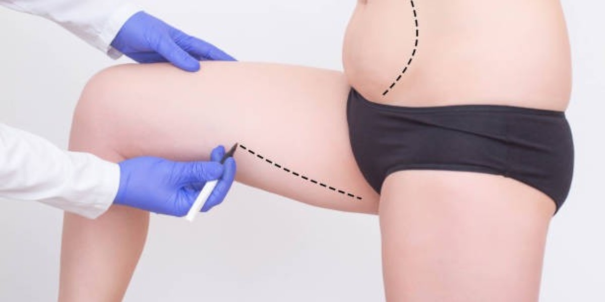 Liposuction in Riyadh and the Benefits of Modern Fat Removal Techniques