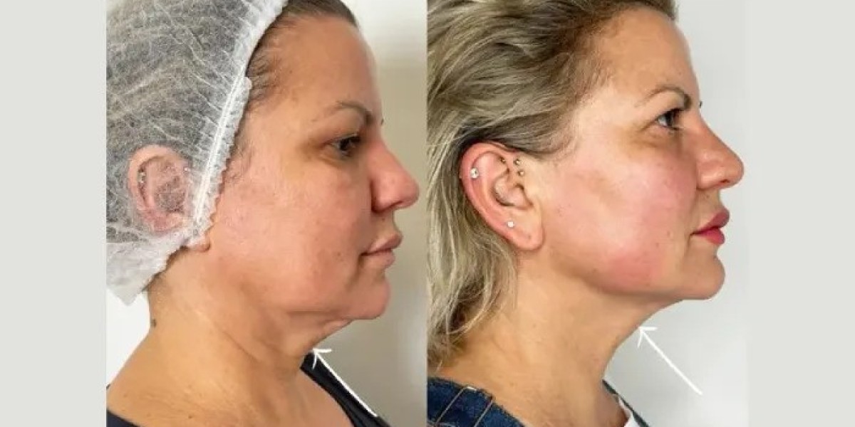 Endolift in dubai for Advanced Facial Skin Tightening and Contouring