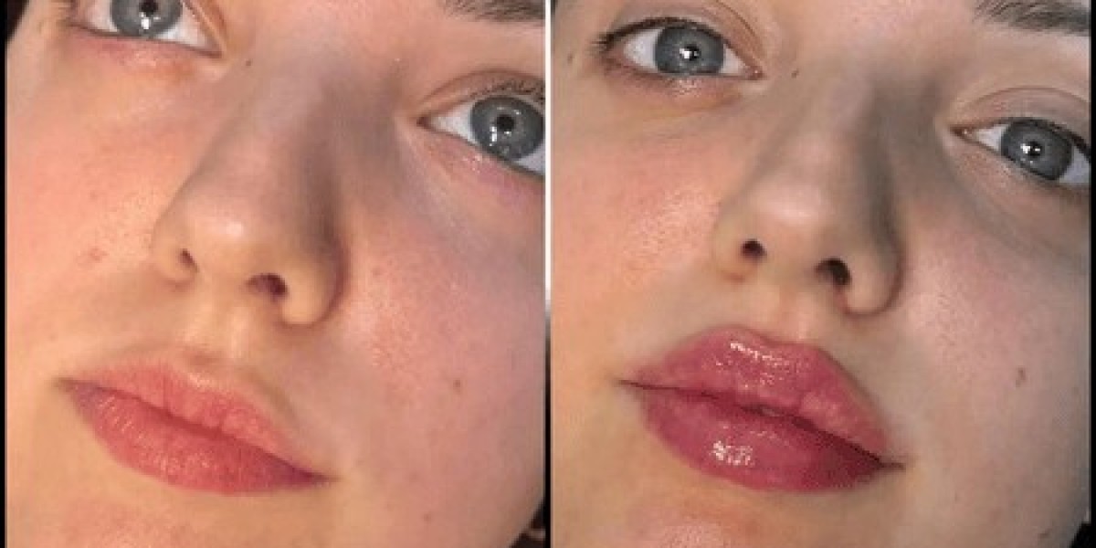 Best Plastic Surgeons in dubai: Targeting Problem Areas with Fillers