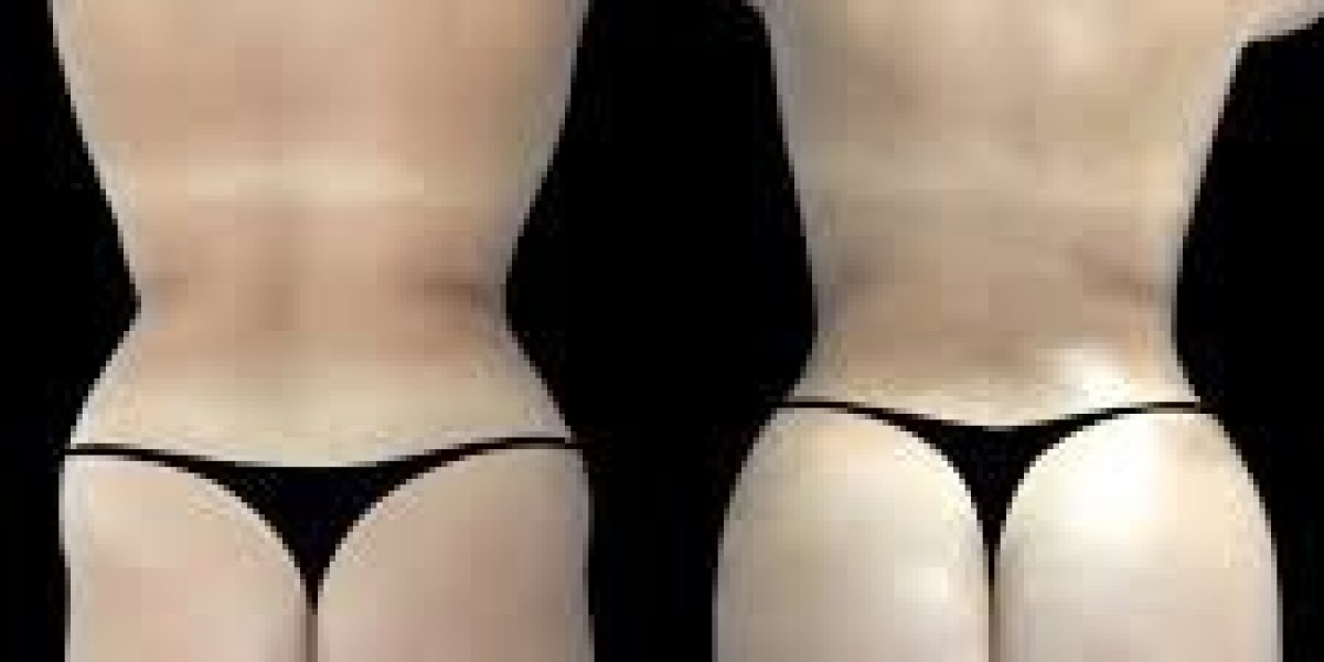 Butt Fat transfer in Dubai: When Can You Return to Work