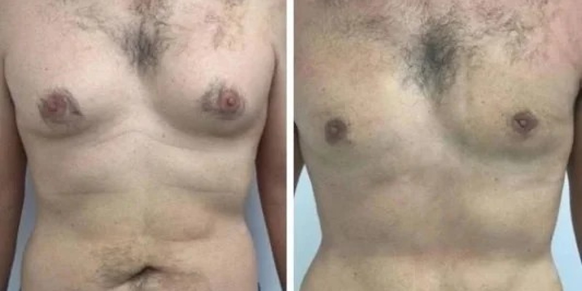Best Doctors in Dubai for Gynecomastia: A Guide to Improved Chest Proportions