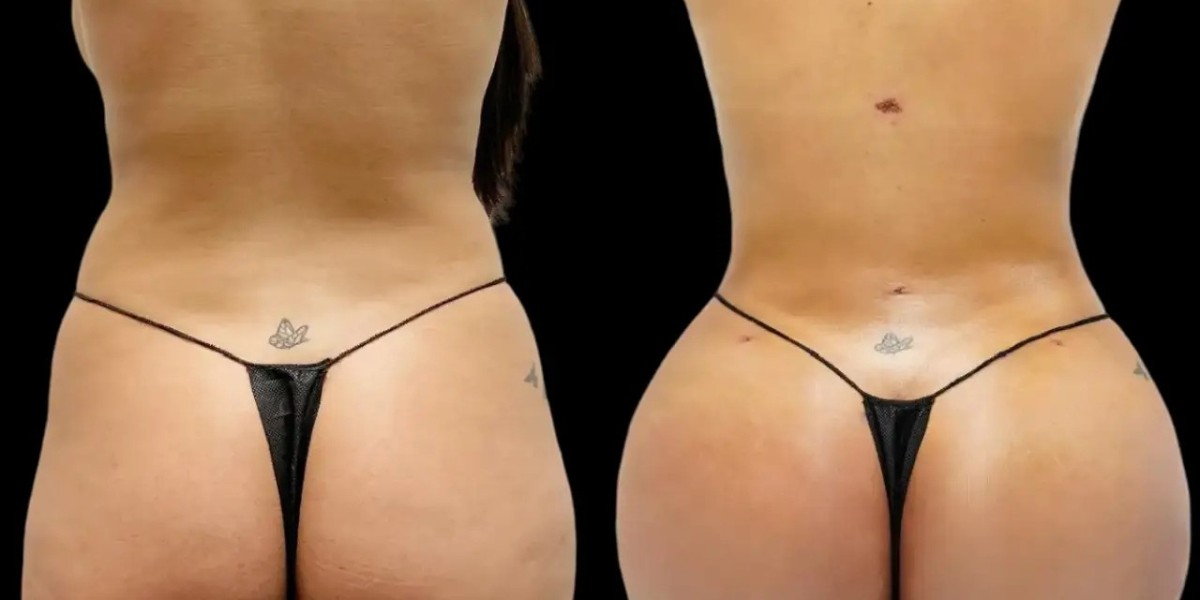 Fat transfer in Dubai: Questions to Ask About Previous Patient Cases