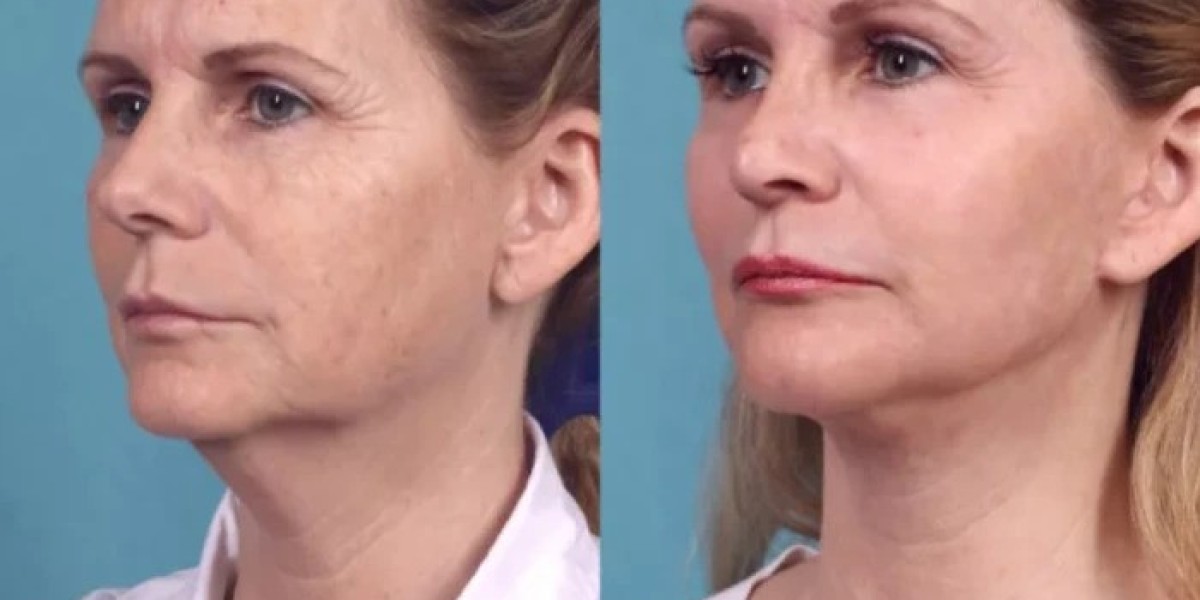 Best Plastic Surgeons in dubai for Chemical Peels and Everyday Skin Maintenance