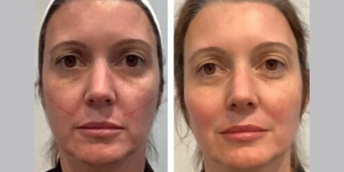 Best Plastic Surgeons in Dubai: Elegant Facial Thread Lift