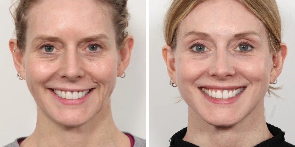 Thread Lift Treatment in Dubai for Mild Facial Laxity