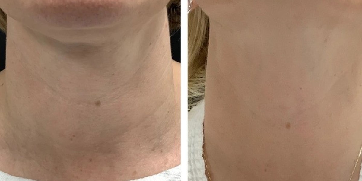 Radiofrequency (RF) Microneedling in Dubai for Radiant-Looking Skin