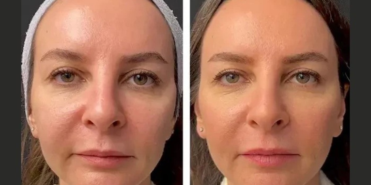 Best Plastic Surgeon in Dubai for Mesotherapy: Fine Lines & Wrinkles