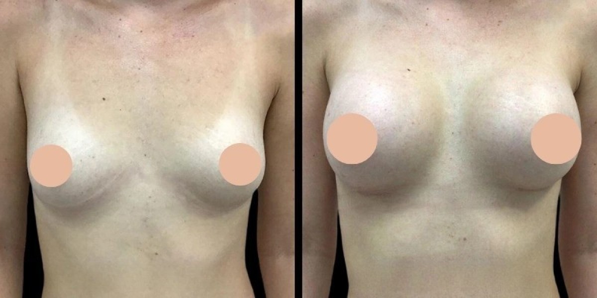 Breast Augmentation Consultation with Best Breast Augmentation Surgeon in Dubai