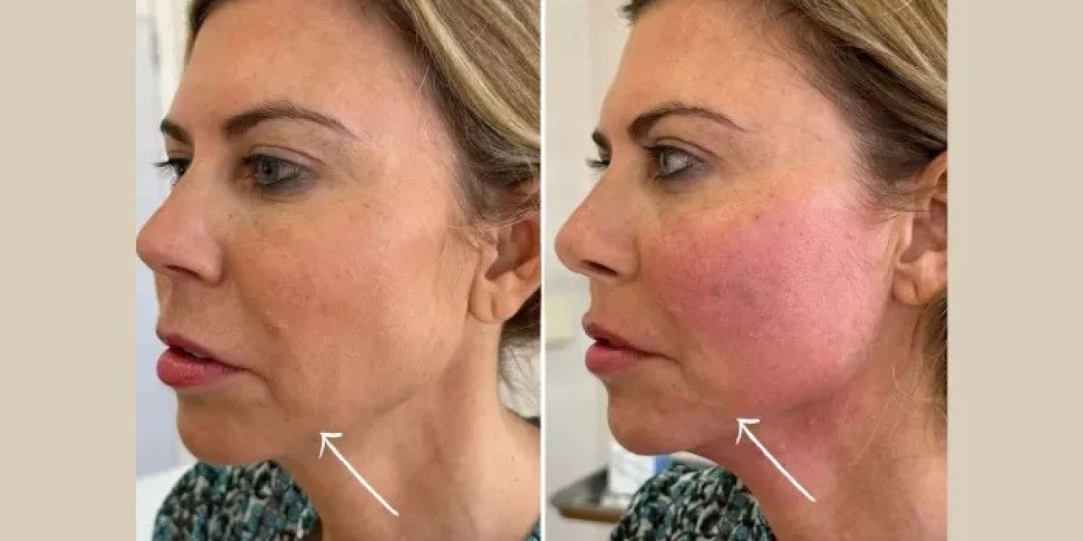 Endolift Treatment in Dubai for Facial Laxity Treatment Options