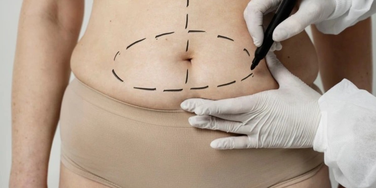 Tummy Tuck Surgery- For Which Conditions Is It Recommended?